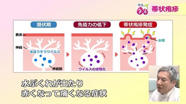 帯状疱疹の発症メカニズム