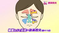 「痰が絡む人は要注意」季節の変わり目に増える副鼻腔炎…慢性化で髄膜炎のリスクも　実は虫歯とも密接な関係が　医師に注意点を聞いた