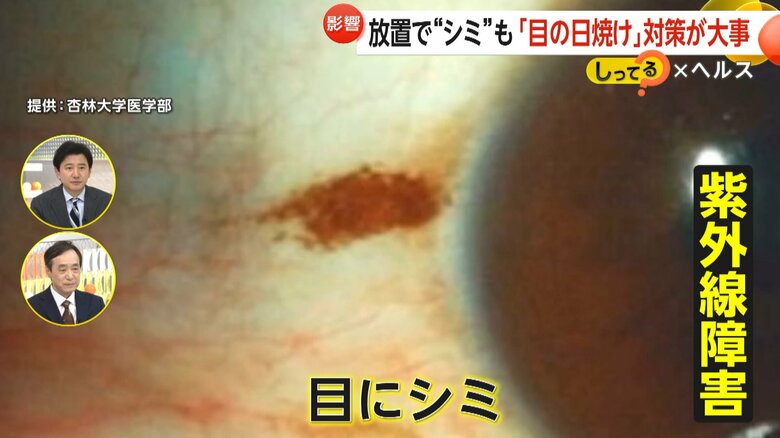 皮膚に出来るのと同じように白目に「シミ」が出来る紫外線障害