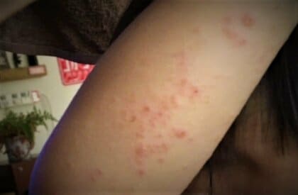 手足にブツブツ 痛みも 各地で『手足口病』が流行し警報レベルに 発熱や喉の痛みの後に“手足に発疹”　幼い子どもだけではなく【大人も注意が必要】 北海道