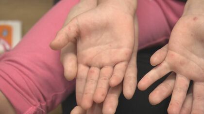 医師「状態次第では髄膜炎にも」5歳以下の子供が感染する“手足口病”が流行中 熱中症との合併等に注意