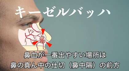鼻血が出たら「上を向く」「ティッシュを詰める」は間違い…理由と