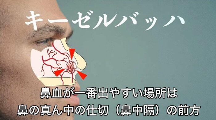 鼻血が一番出やすい場所「キーゼルバッハ」(提供:一般社団法人 日本耳鼻咽喉科頭頸部外科学会)