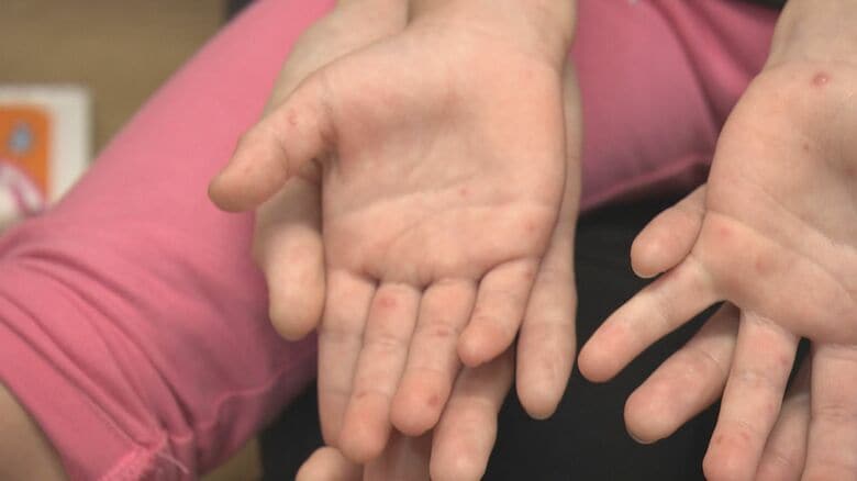 医師「状態次第では髄膜炎にも」5歳以下の子供が感染する“手足口病”が流行中 熱中症との合併等に注意｜FNNプライムオンライン