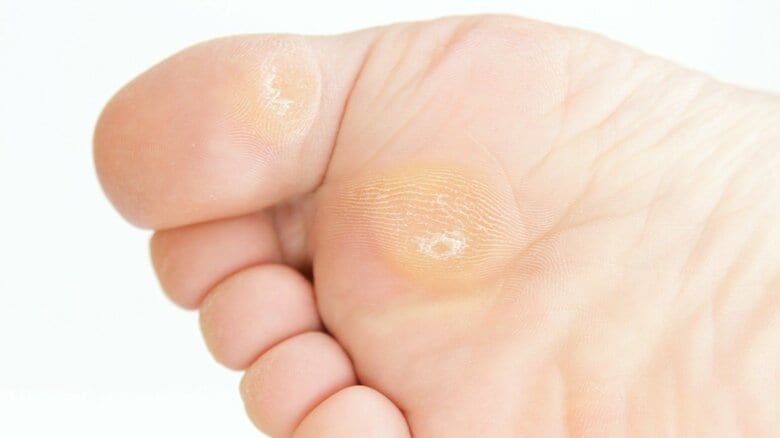 タコとウオノメは自分で取っても大丈夫?削るなら入浴直後のタイミング…角質が硬く分厚くなる仕組みと正しい治し方|FNNプライムオンライン