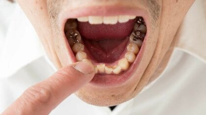 歯の詰め物には“水銀”を含む金属も。歯科医が警告する「アマルガム」の毒性…保険適用もあるメタルフリー治療のすすめ