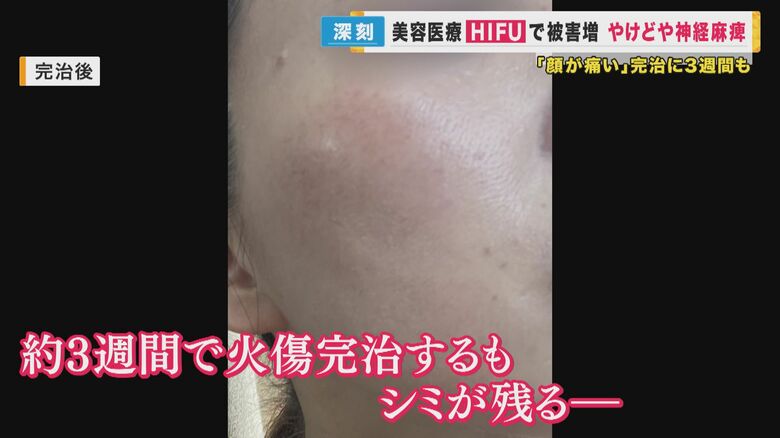 約3週間でやけど完治も　シミが残る