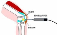 注射針ほどの“極細”内視鏡で患者の負担軽減…レンズは光ファイバー　開発した慶大教授にメリットを聞いた