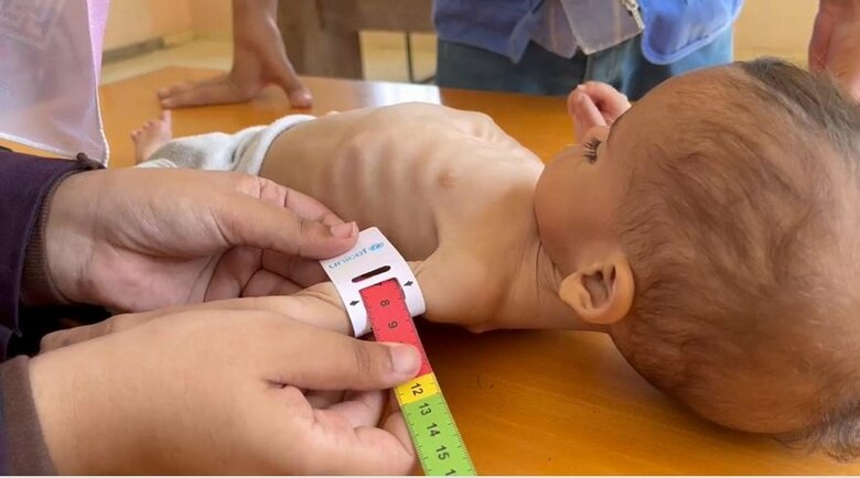 7月に栄養失調状態でUNRWAの診療所に運ばれた生後11カ月のシラちゃん（UNRWA提供）