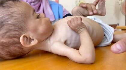 乳児の腕回りが大人の親指ほどに…「7.5センチは人災による飢饉」痩せ細った腕が語るガザ地区の現状