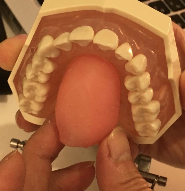 舌の安静位（提供：アンチエイジングデンタルクリニック恵比寿）