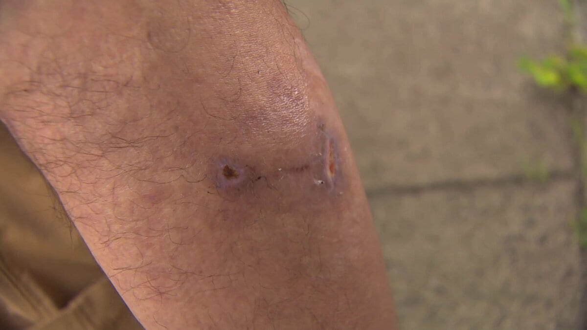 独自】「牙が食い込んだ」熊と“格闘”60代男性が負傷 岩手では住宅街