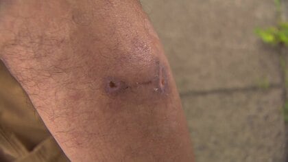 【独自】「牙が食い込んだ」熊と“格闘”60代男性が負傷　岩手では住宅街近くに熊が7時間居座り“ハチミツ作戦”　専門家「2025年は“子連れ熊“多い」