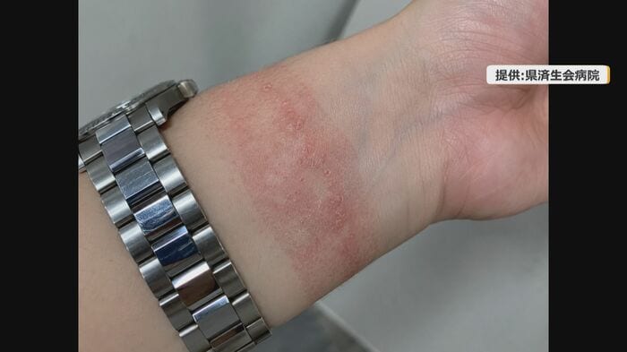 汗をかきやすい季節は特に注意が必要