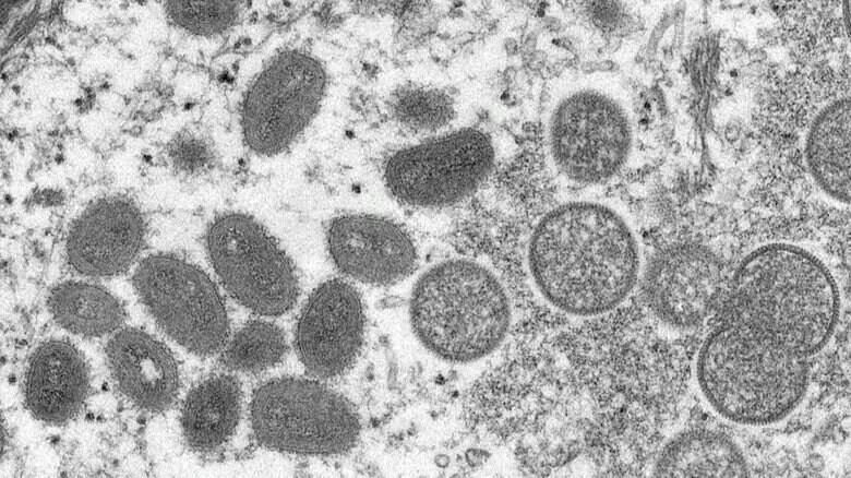 【速報】「サル痘」感染100人超える　今年に入り急増　厚労省｜FNNプライムオンライン