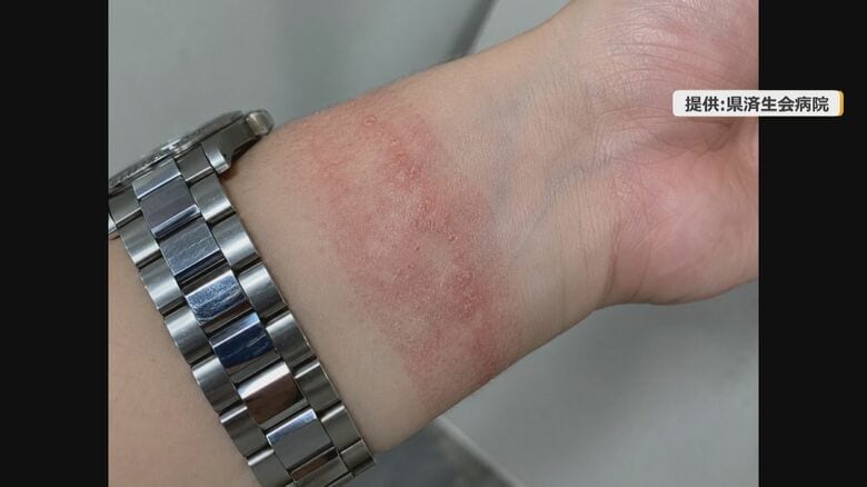 汗をかきやすい季節は特に注意が必要