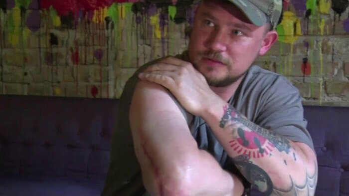 銃撃を受けた右腕には大きな傷跡が