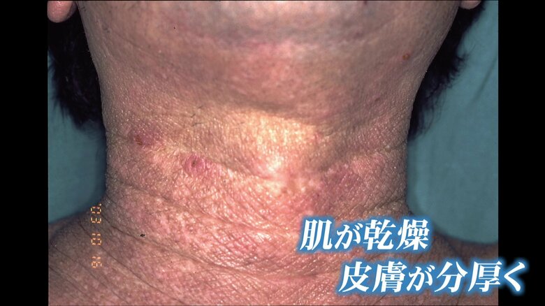 大人になるにつれ症状が上半身に集中する