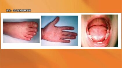 5年ぶりの警報　高知県で夏の感染症・手足口病が急増　早い時期から警報値超える　乳幼児の抵抗力低下が原因か