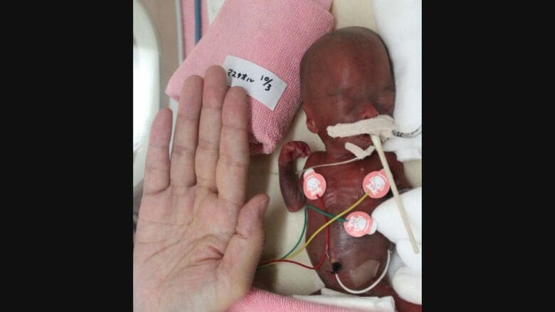 手のひらの大きさで生まれる（提供：県立こども病院）