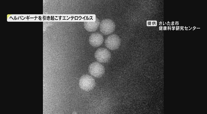 ヘルパンギーナを引き起こすエンテロウイルス 提供:さいたま市健康科学研究センター