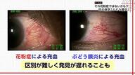 失明の恐れも…『花粉症と酷似』年間5万人発症の“目の病気”「ぶどう膜炎」　「見分け方」と「早期受診の重要性」を専門医に聞いた
