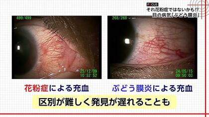失明の恐れも…『花粉症と酷似』年間5万人発症の“目の病気”「ぶどう膜炎」　「見分け方」と「早期受診の重要性」を専門医に聞いた