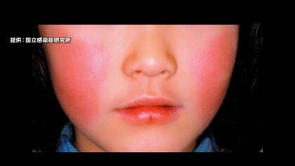 【注意】「リンゴ病」患者数が4週連続で増加　埼玉、東京で“警報レベル”超え…「マイコプラズマ肺炎」患者数は減少も例年より高水準続く