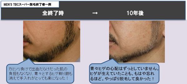 満足度９６ ６ Men S Tbcスーパー脱毛 はここまでスゴかった ヒゲ脱毛体験キャンペーン実施中