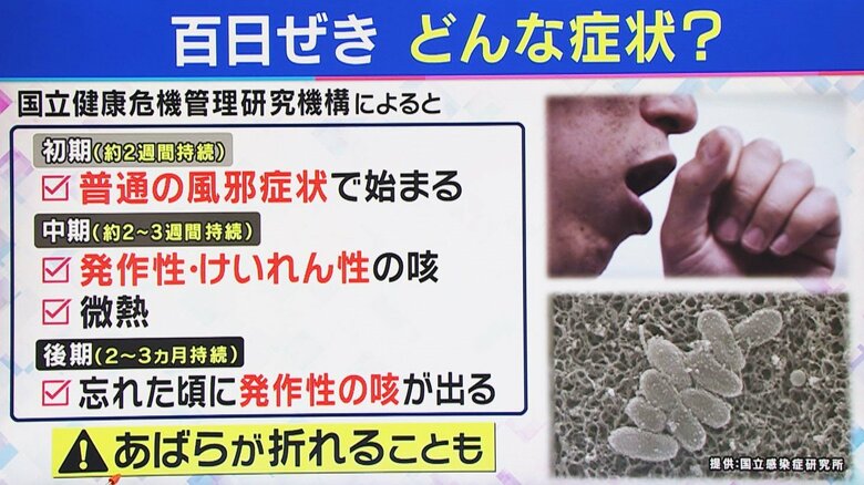 百日ぜきの症状 関西テレビ「旬感LIVEとれたてっ！」より
