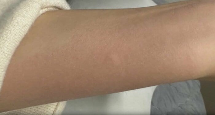 刺されると激しいかゆみに襲われる