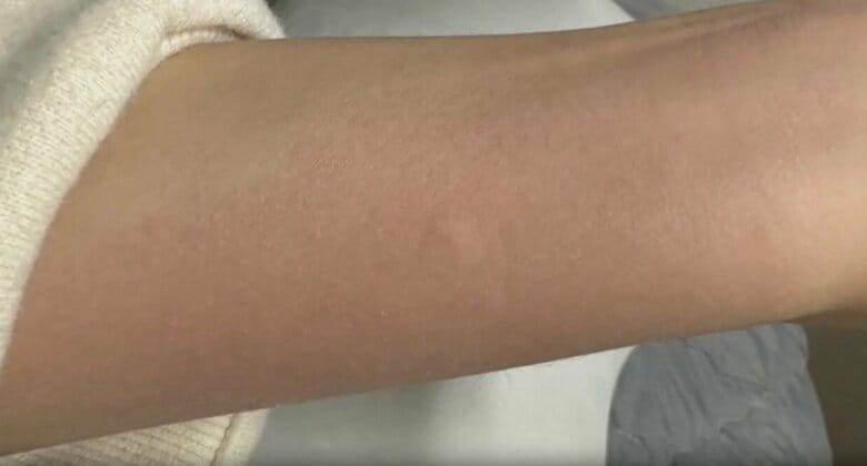 刺されると激しいかゆみに襲われる