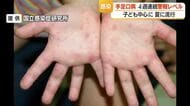手足口病・患者数315人（前週比-76人）も4週連続警報レベル　タオル共用避けこまめな手洗いを　山形