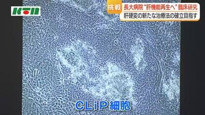  新たな治療法　長崎大学病院「CLiP細胞を用いた肝臓再生医療」の臨床研究を開始　５～１０年後の実用化目指す