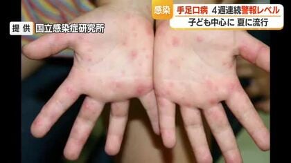 手足口病・患者数315人（前週比-76人）も4週連続警報レベル　タオル共用避けこまめな手洗いを　山形