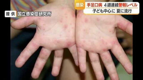 手足口病・患者数315人（前週比-76人）も4週連続警報レベル　タオル共用避けこまめな手洗いを　山形