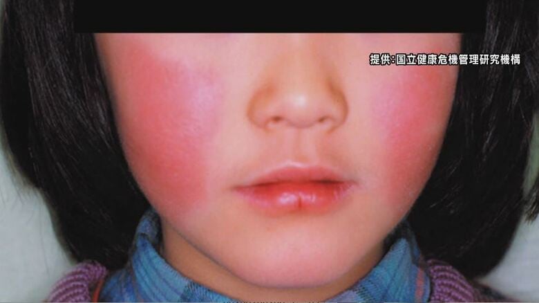 「りんご病」が流行中　「百日せき」も例年より多い状態続く　長野県が注意呼びかけ｜FNNプライムオンライン