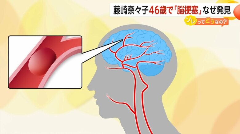 脳の血管が詰まって血流が悪くなり、脳細胞がダメージを受ける脳梗塞