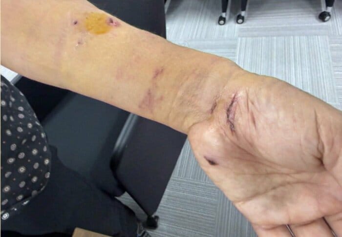 男性が腕に負ったきず（提供：伊藤優太仙台市議）
