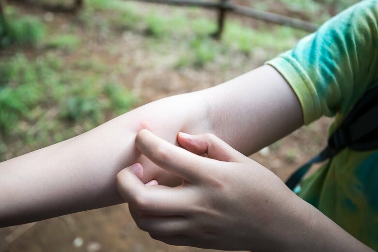 ブヨに刺されると猛烈な痒みに襲われる（画像はイメージ）