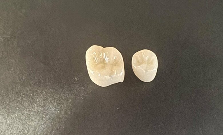 虫歯治療であれば保険適用になるCAD/CAM冠（提供：アンチエイジングデンタルクリニック恵比寿）