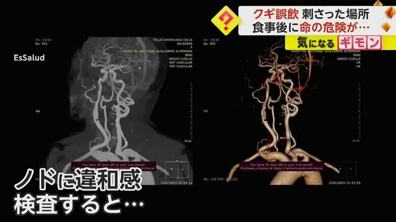 喉にクギが刺さった女性のレントゲン写真