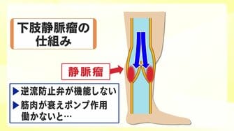 ボコボコの血管 放置すると穴が 7割の人にある 下肢静脈瘤 接着剤 使う画期的治療法も 石川発