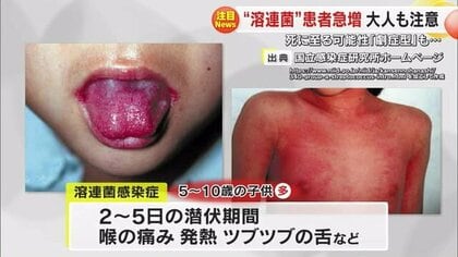 溶連菌」の感染が止まらない…患者が過去10年で最多 大人も要注意！手足