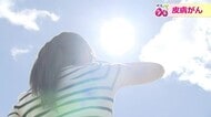 それって本当にホクロ？　紫外線ダメージが“悪性”「皮膚がん」に進行も…　専門医が解説