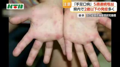 乳幼児に多い「手足口病」　長崎県内で5週続けて増加　県内の発症は約９割が２歳以下