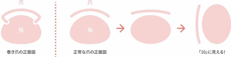 巻き爪・正常な爪の正面図
