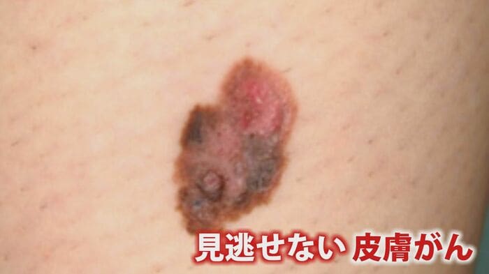 見逃せない皮膚がん