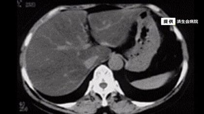「肝臓」脂肪が急増…コロナ禍の運動不足も原因？放置すればがんの恐れも 予防法をご紹介【福井発】