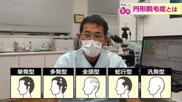 円形脱毛症の種類